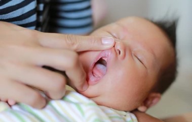Home Remedies para sa Singaw ng Baby